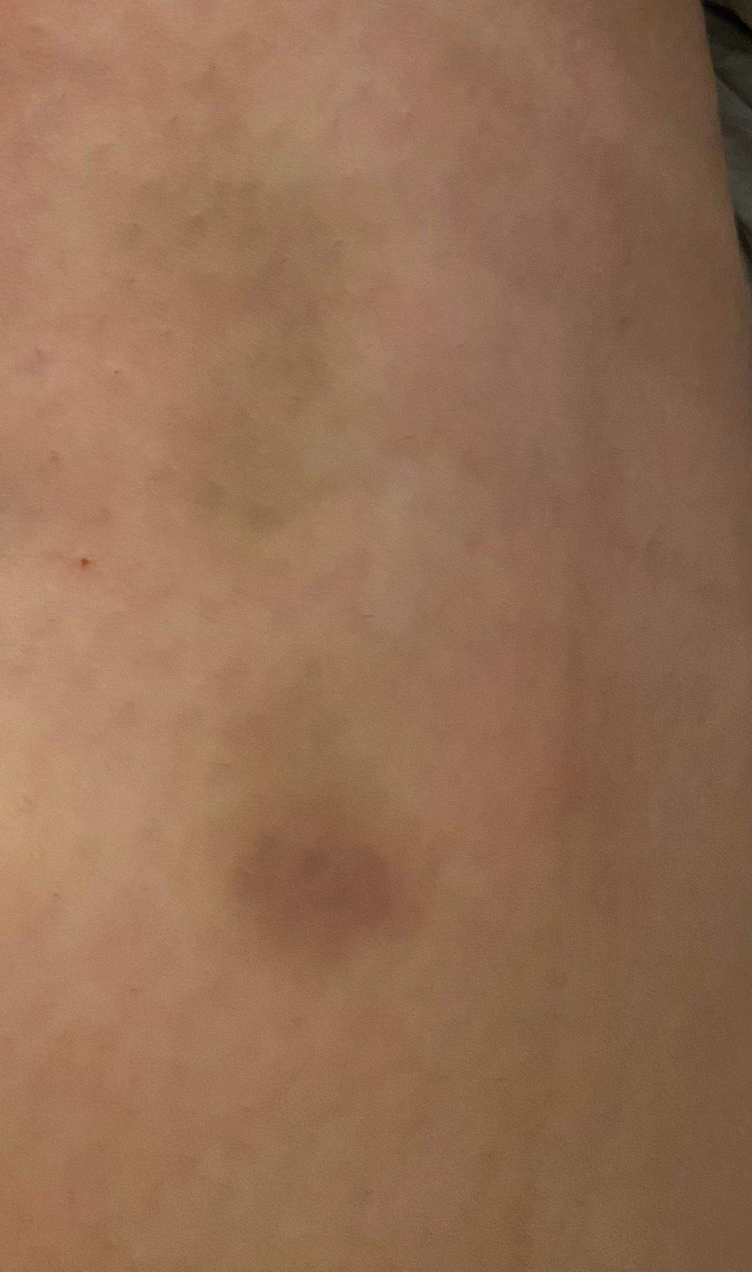 Blaue Flecken ohne Grund, Symptom für Leukämie? (Haut, Symptome)