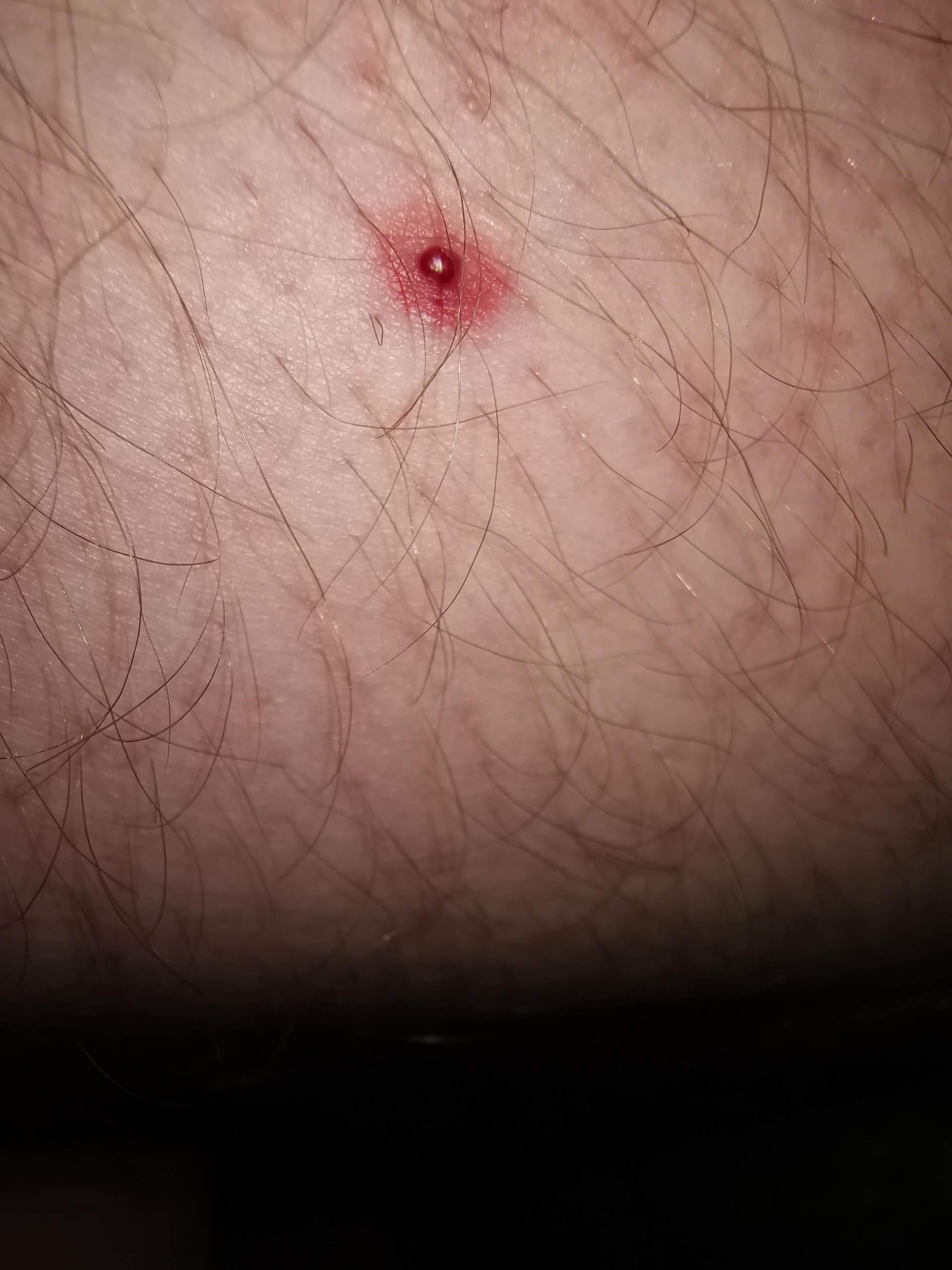 Kleine Blutblase Auf Der Haut