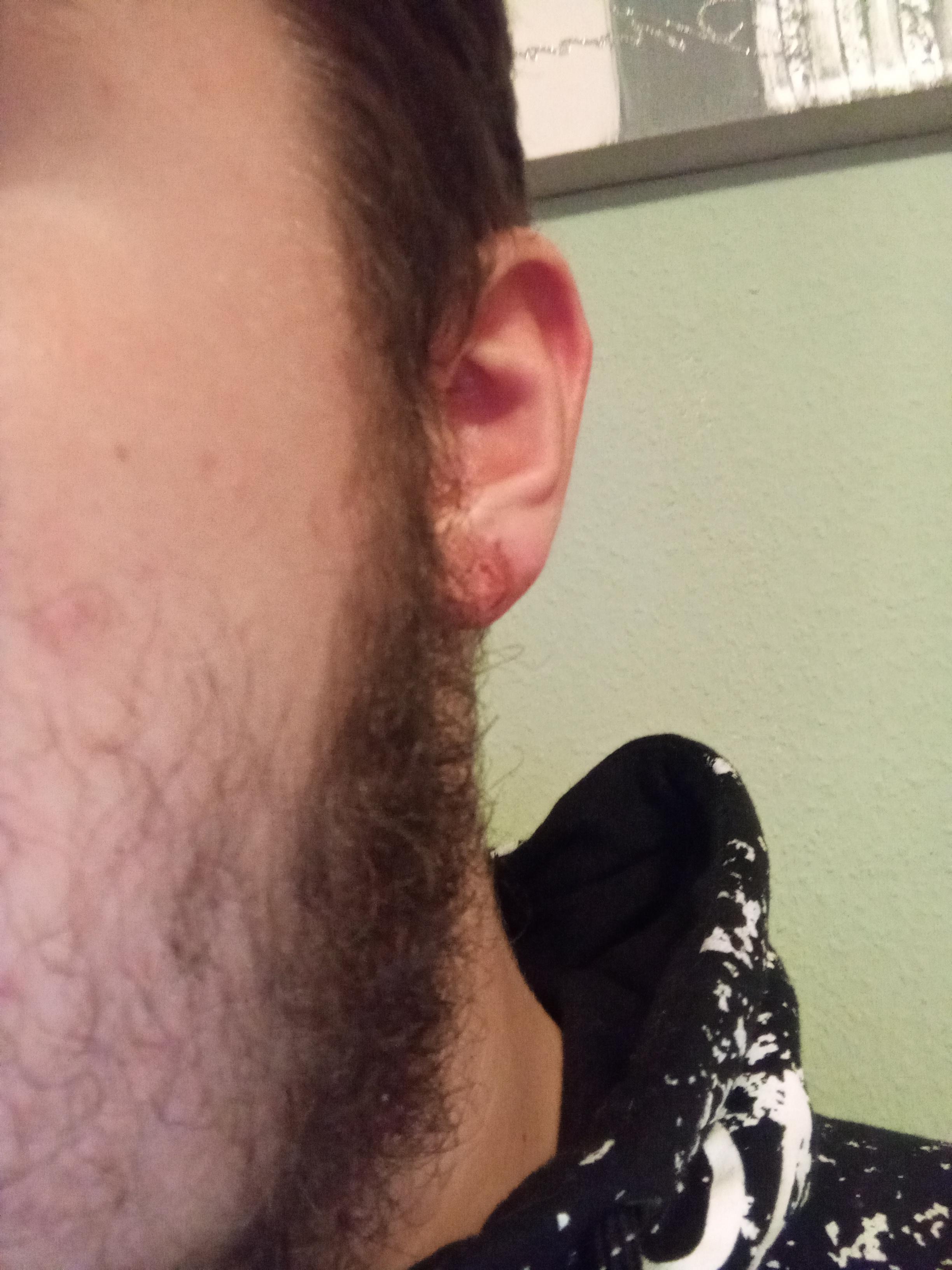 Bluterguss nach Ohrloch stechen?