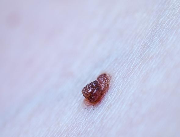 Muttermal - (Dermatologie, Hautkrebs, Muttermal)
