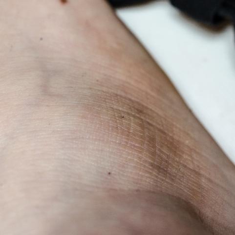 Fuß - (Dermatologie, Hautkrebs, Muttermal)