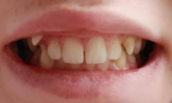 Brauche ich eine Zahnspange?Wenn ja welche?