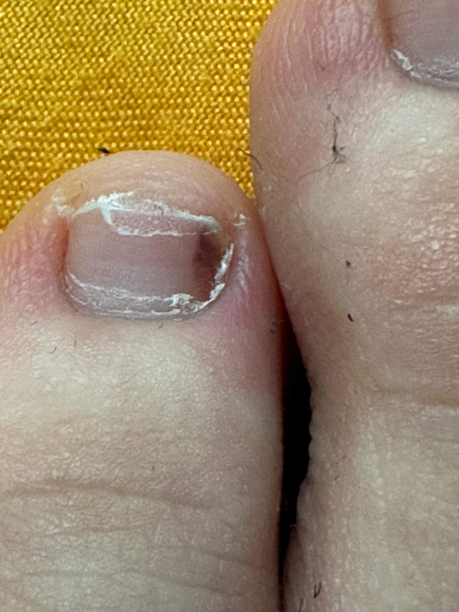 Brauner Fleck am Fußnagel? (Krebs, Fußnägel)