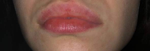 Brennende rote Lippen? (Brennen, Lippe)