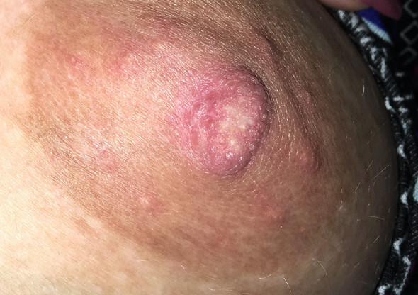 - (Schwangerschaft, Brust, Warzen)