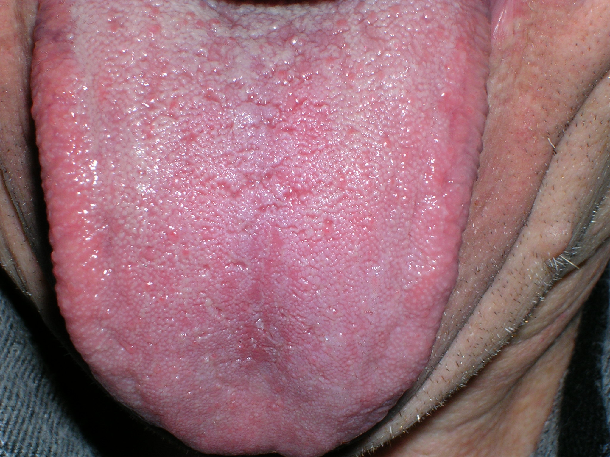 35++ Pilz auf der zunge bilder , Candidas Albicans (Entzündung, Lunge, Atemwege)