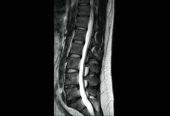 Ist das hier ein Bandscheibenvorfall oder eine Bandscheibenwölbung Ist das hier ein Bandscheibenvorfall oder eine Bandscheibenwölbung