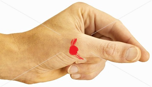 Daumen abgeknickt - nur überdehnt ? (Orthopädie, bänderriss, Fraktur)