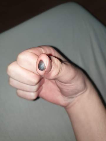- (Verbrennung, Daumen, Feuerzeug)