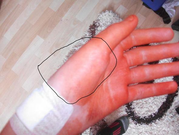Daumen Fuhlt Sich Nach Op Taub An Foto Operation Krankenhaus Taubheitsgefuhl Daumen Fuhlt Sich Nach Op Taub An Foto Operation Krankenhaus Taubheitsgefuhl