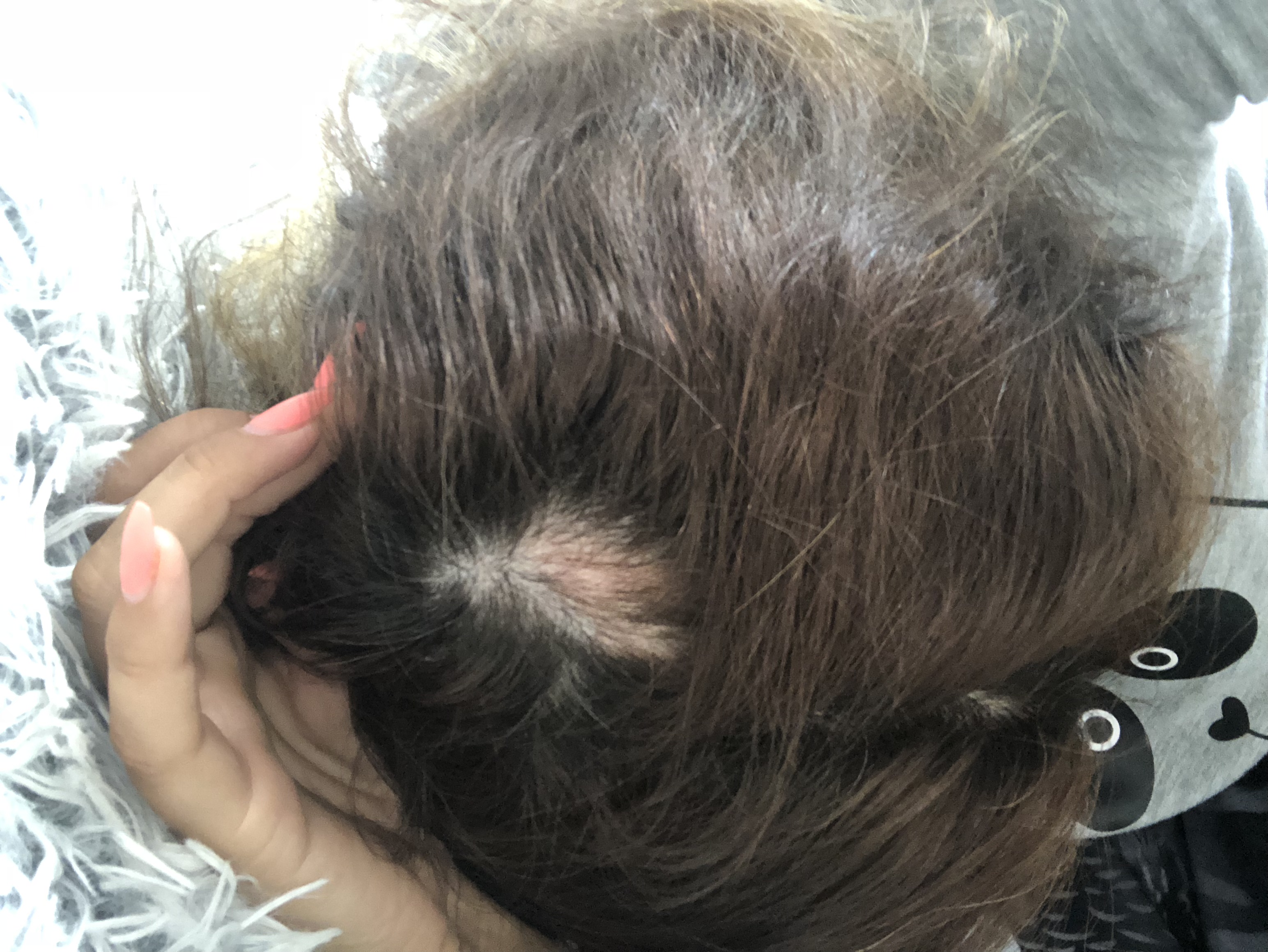 Delle Am Kopf Mit Haarausfall