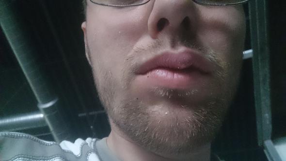 Blase an der Lippe - (Haut, Blase, Lippe)