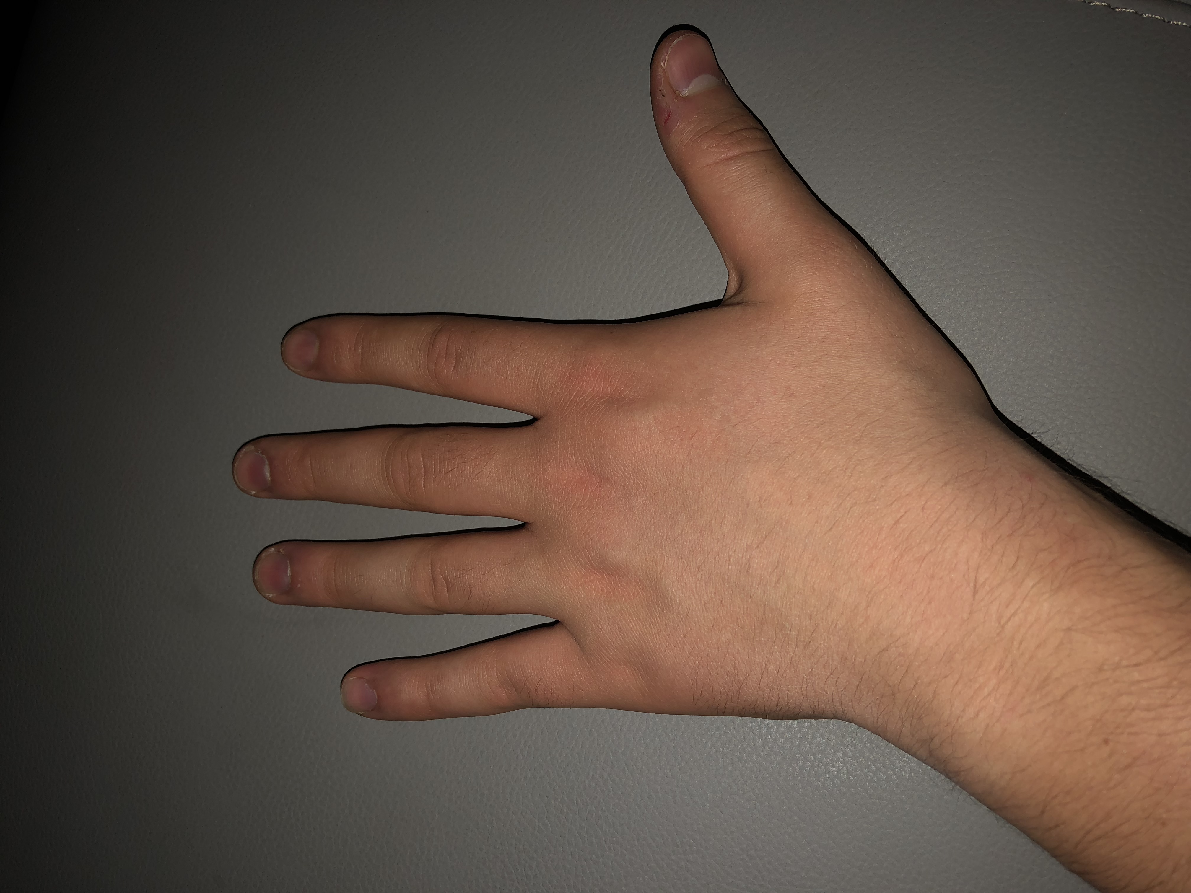 Dicke Hände? (Hand, Finger)