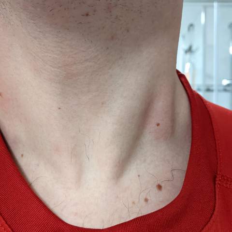 Dicke Stelle am Hals beim Vorstrecken am Hals: Lymphknoten?