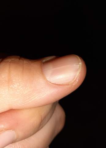 dicker, langer weißer & schmerzhafter Streifen unter dem fingernagel?
