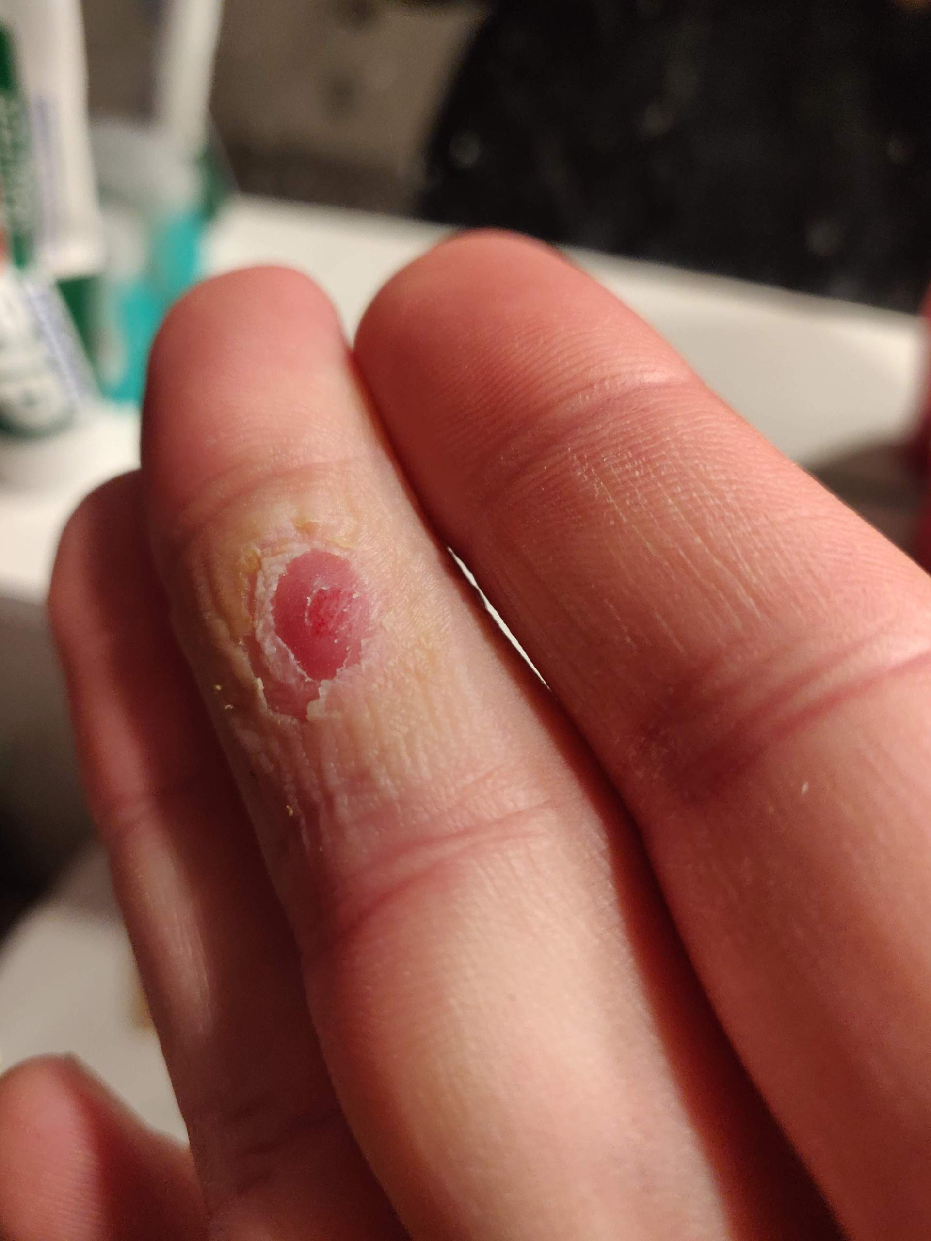 Dornwarze am Finger? (Warzen)