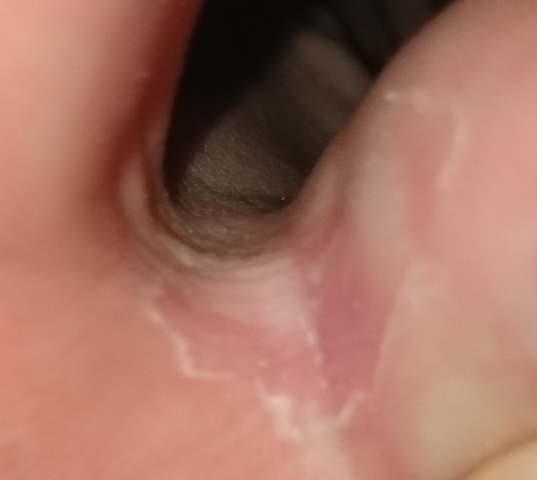Dornwarzen Huhneraugen Und Fusspilz Haut Dermatologie Warzen Dornwarzen Huhneraugen Und Fusspilz Haut Dermatologie Warzen