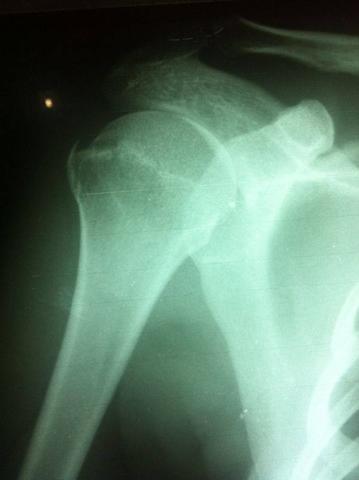 R1 - (Operation, Orthopädie, Schulter)
