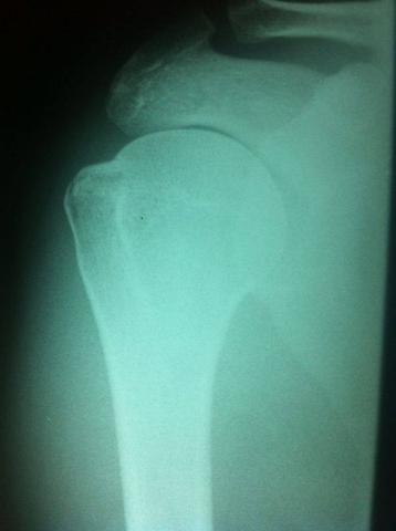 R2 - (Operation, Orthopädie, Schulter)