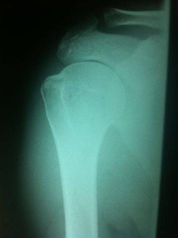 R3 - (Operation, Orthopädie, Schulter)