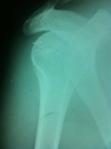 R4 - (Operation, Orthopädie, Schulter)
