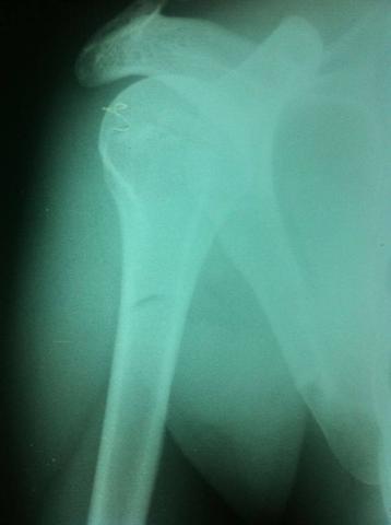 R5 - (Operation, Orthopädie, Schulter)