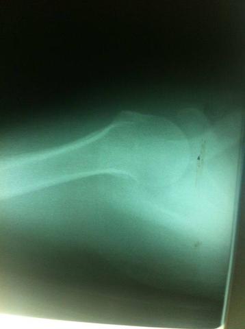 R7 - (Operation, Orthopädie, Schulter)