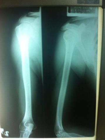 R8 - (Operation, Orthopädie, Schulter)