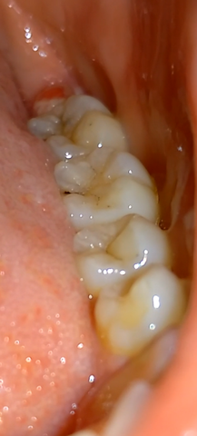 Zahn grau karies