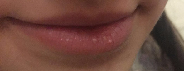 Durchsichtige/ weiße Bläschen auf der Lippe - was kann das sein?