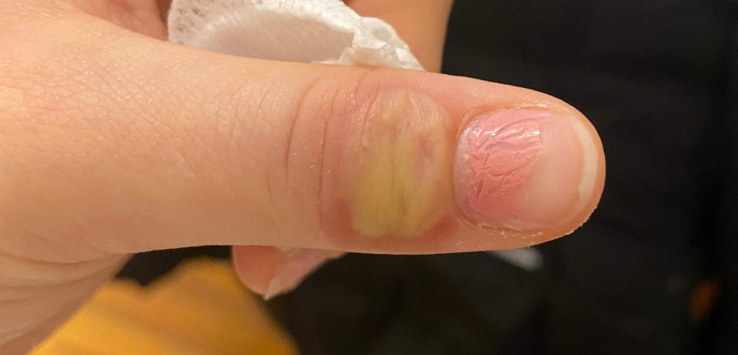 Eiter auf dem Finger, was soll ich machen? (Schmerzen, Gesundheit
