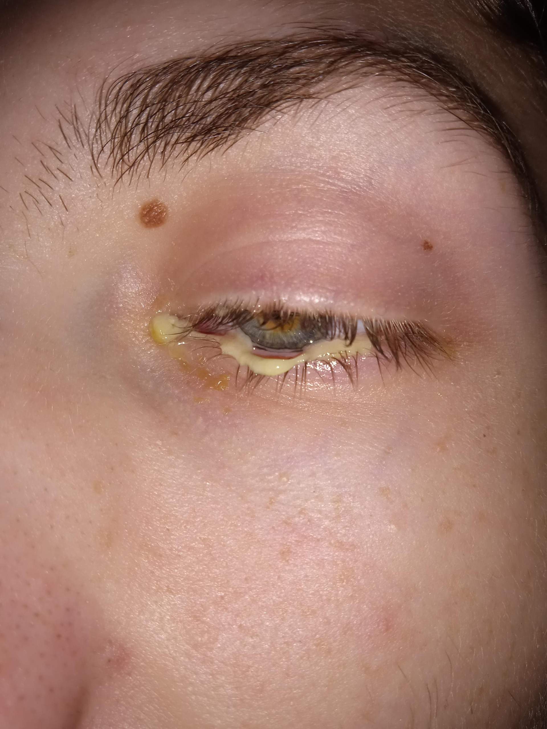 Eiter im Auge was tun? (Augen, Entzündung, Hilfe)