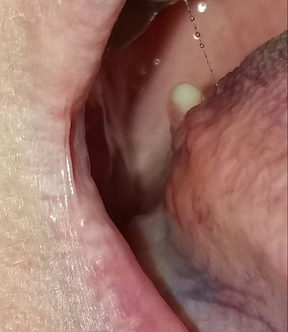 Eiterblase  - (Entzündung, Blase, Zunge)