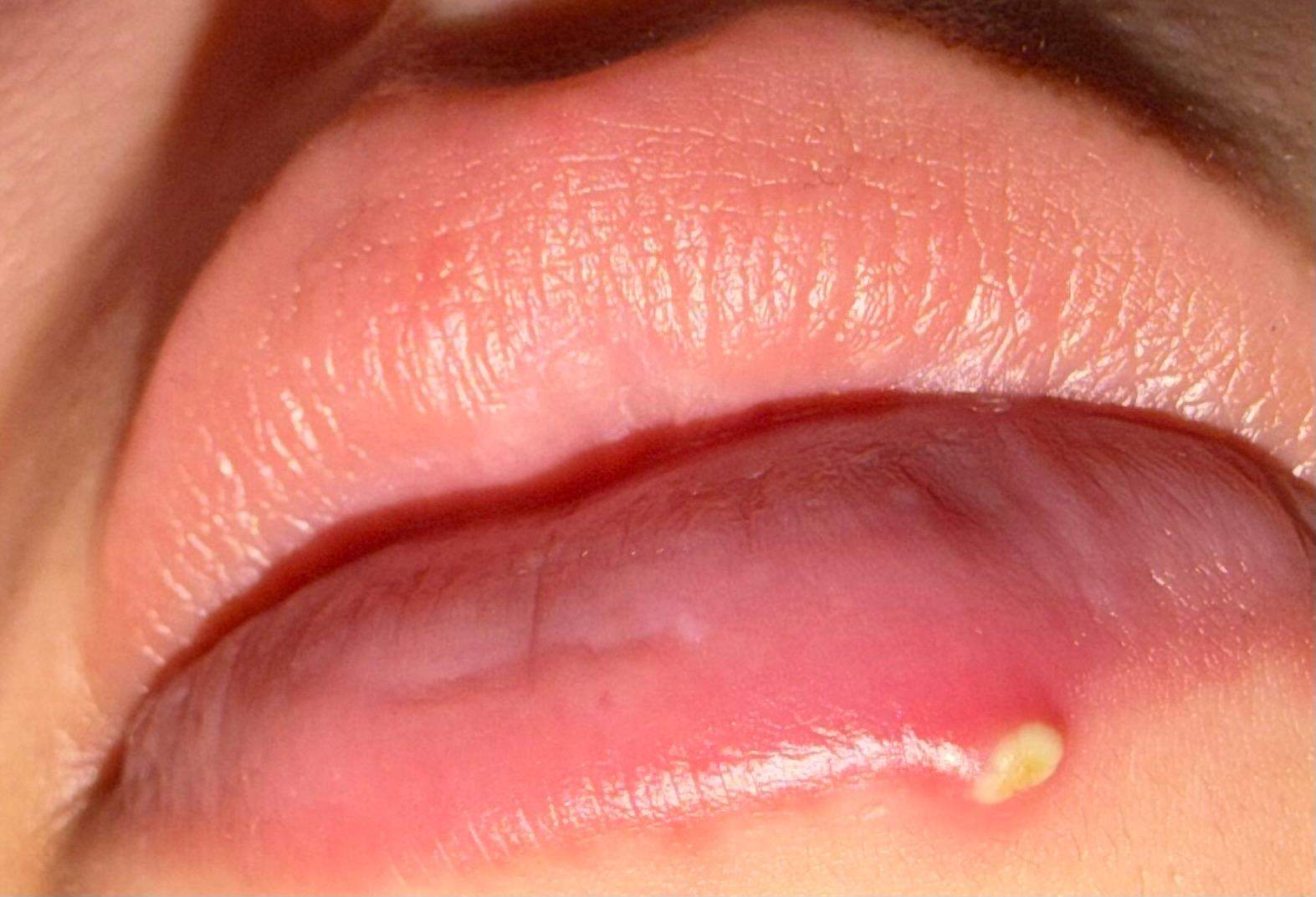 Pickel Unter Lippe