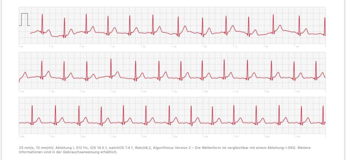 Normal Apple Watch EKG Nehru Memorial