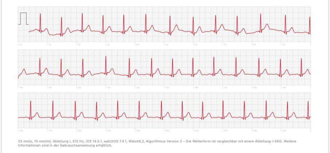 Ekg normal (Apple Watch 6)? (Herz)