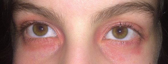 Meine Augen - (Haut, Augen, Allergie)