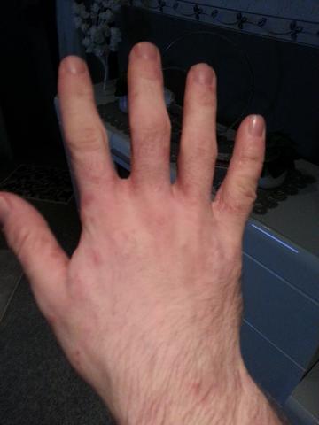 Hand 5 - (Allergie, Ekzem, Hausstauballergie)