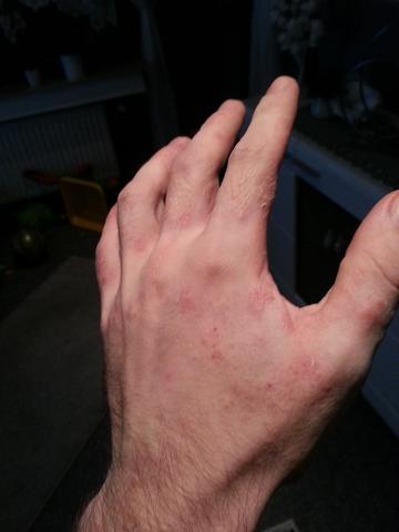 Hand 6 - (Allergie, Ekzem, Hausstauballergie)