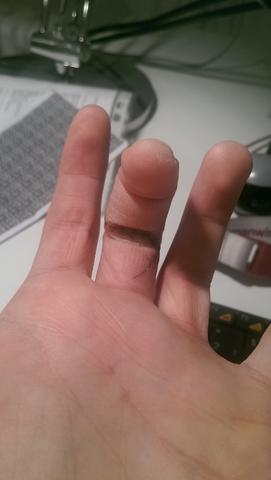 Finger - (Operation, Hand, Wunde)