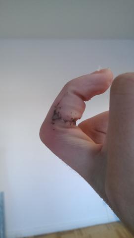 Finger - (Operation, Hand, Wunde)