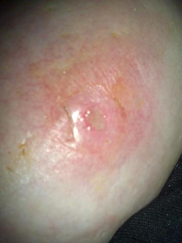 Entzundete Wunde Unter Der Brust Schaut Euch Das Mal An Bild Eingefugt Entzundung Entzundete Wunde Unter Der Brust Schaut Euch Das Mal An Bild Eingefugt Entzundung