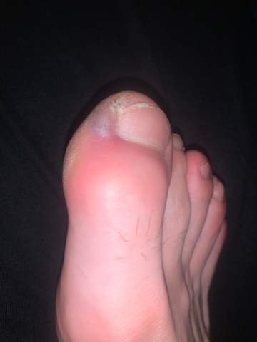 Entzundung Am Fuss Fusse Entzundung Am Fuss Fusse