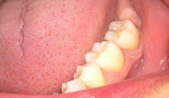 Entzündung des Zahnfleischs ohne dass es rot ist?