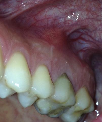 Entzündung über dem Zahn, was könnte das sein? (mit Foto)