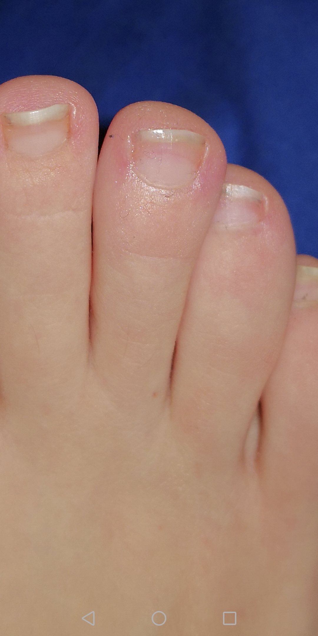 Enzündung am Zeh? (Schmerzen, Entzündung) Enzündung am Zeh? (Schmerzen, Entzündung)