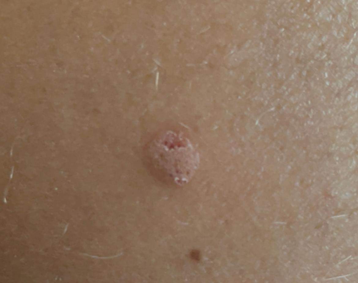 Erhebung der Haut? (Hautkrebs)