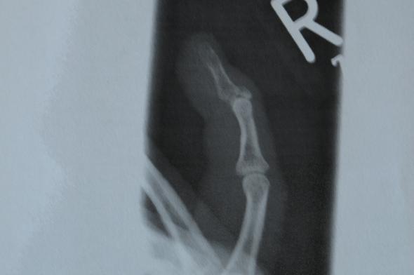 Röntgenbild nach 10 Wochen - (Sprunggelenk, Orthopäde, Sportverletzung)