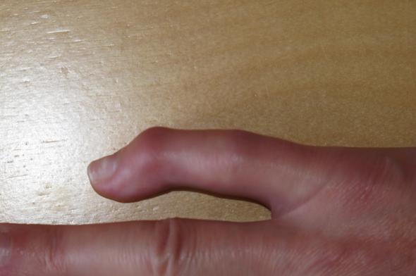 Erneute Op Bei Fehlerhafter Verheilung Fraktur Kleiner Finger Sinnvoll Orthopade Sprunggelenk Sportverletzung Erneute Op Bei Fehlerhafter Verheilung Fraktur Kleiner Finger Sinnvoll Orthopade Sprunggelenk Sportverletzung