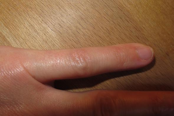 Erneute Op Bei Fehlerhafter Verheilung Fraktur Kleiner Finger Sinnvoll Orthopade Sprunggelenk Sportverletzung Erneute Op Bei Fehlerhafter Verheilung Fraktur Kleiner Finger Sinnvoll Orthopade Sprunggelenk Sportverletzung